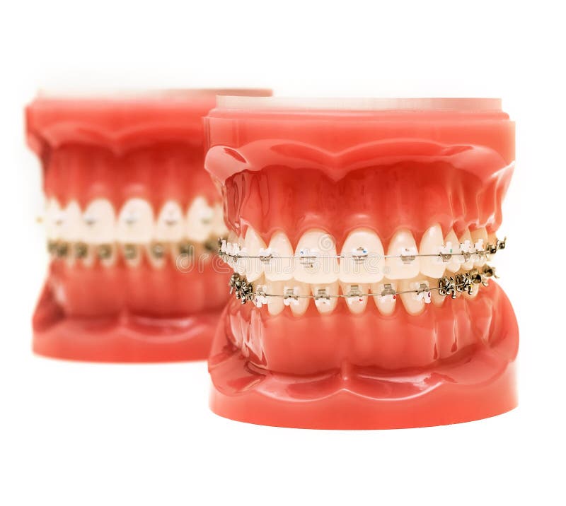 Dentist Demonstration Teeth Model Of Orthodontic Bracket System Stock Image Image Of Care 