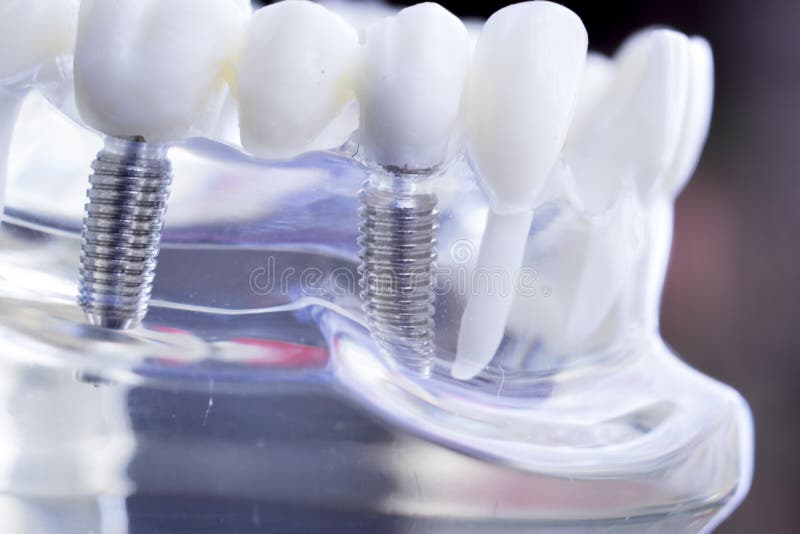 Zubní zuby výuka zobrazené titan kov zub implantát šroub.