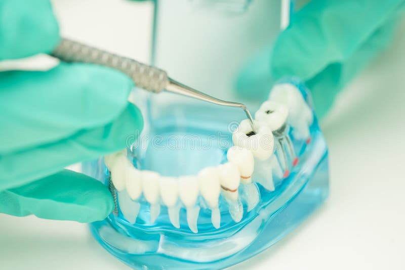 Dentist hand demonstrate to use dental tool cleaning caries stock photography Dentist hand demonstrate to use dental tool cleaning caries stock photography