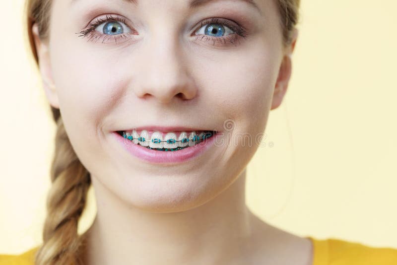 Young Woman Showing Teeth Braces Stock Image - Image of smile ...