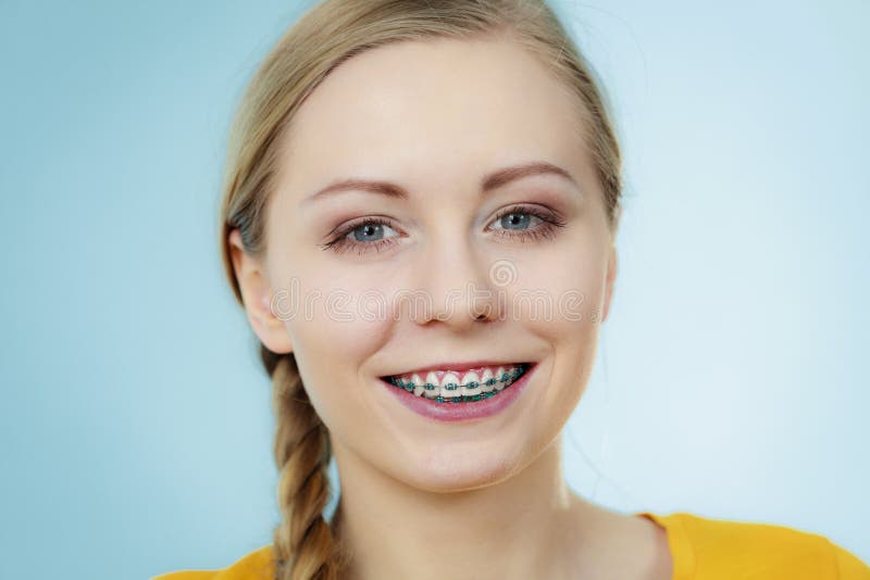 Young Woman Showing Teeth Braces Stock Photo - Image of orthodontics ...
