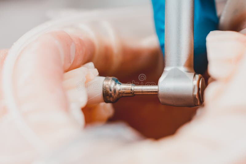 The Dentist Polishes the Teeth with a Drill, a Dental Procedure. Teeth Polishing Macro Stock