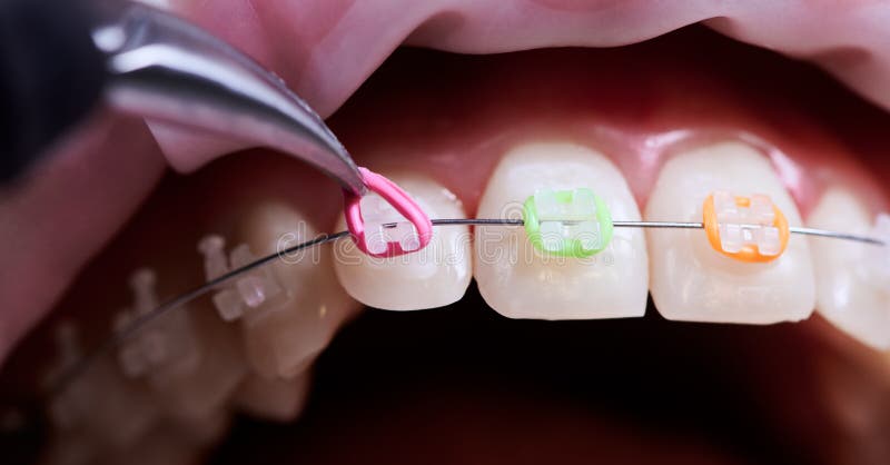 Dentiste Enlever Les Bandes De Caoutchouc Des Accolades Du Patient. Photo  stock - Image du bouche, dentaire: 229553298