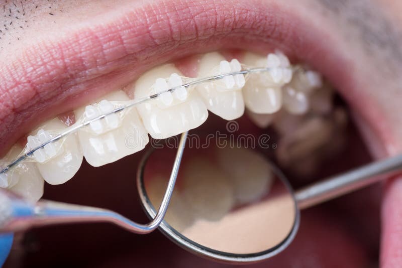 Dentiste vérifiant vers le haut des dents avec les parenthèses en céramique utilisant les outils dentaires - sonde et miroir