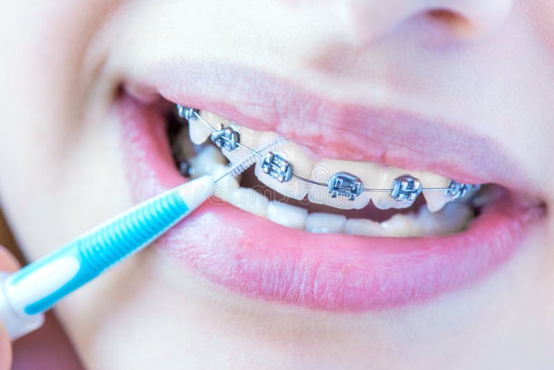 Dents avec des supports photo libre de droits Dents avec des supports photo libre de droits