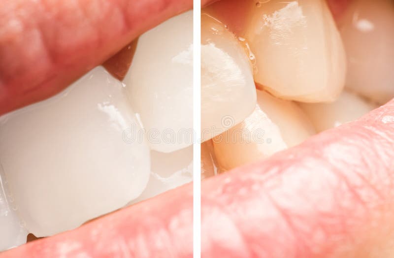 Woman Teeth Before And After Whitening Procedure At Dentist Clinic. Woman Teeth Before And After Whitening Procedure At Dentist Clinic