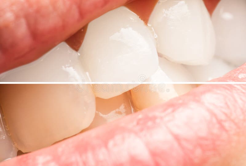 Woman Teeth Before And After Whitening Procedure At Dentist Clinic. Woman Teeth Before And After Whitening Procedure At Dentist Clinic