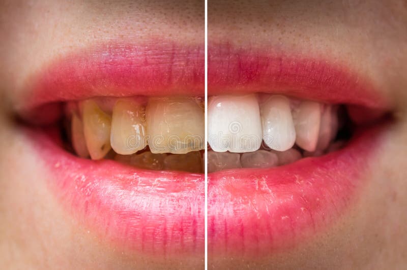 Dents de femme avant et après le traitement dentaire images libres de droits Dents de femme avant et après le traitement dentaire images libres de droits