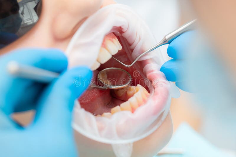 Dents Dentiste Bouche Miroir Gros Plan Examen Des Dents Avec Miroir Dentaire  Dents Idéales Outils Dentaires