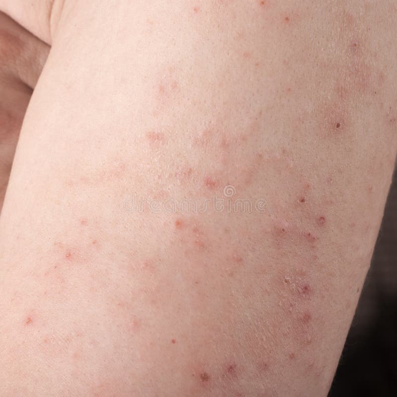 Dermatitis Alergiczna Wysypka Obraz Stock - Obraz złożonej z infekcja