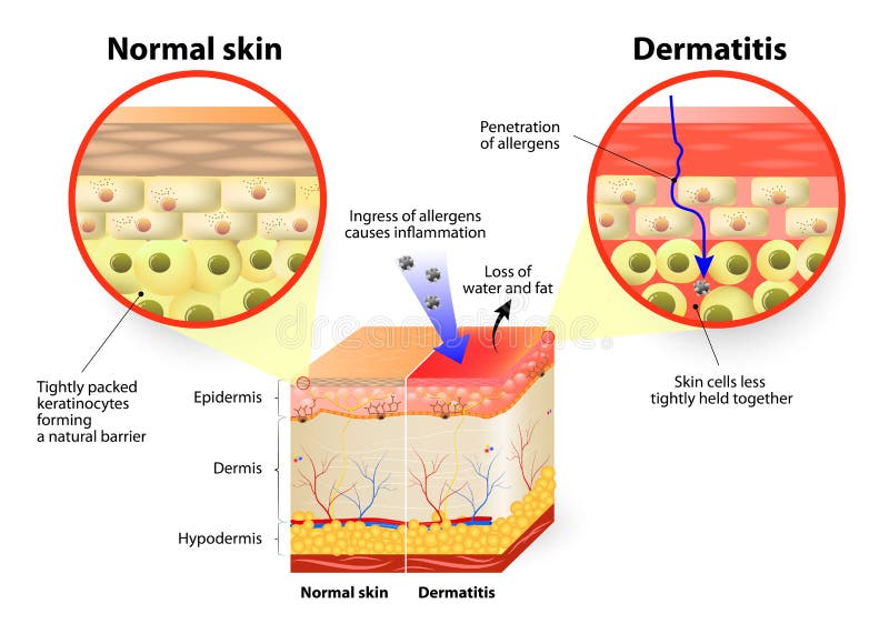 Dermatitis or eczema