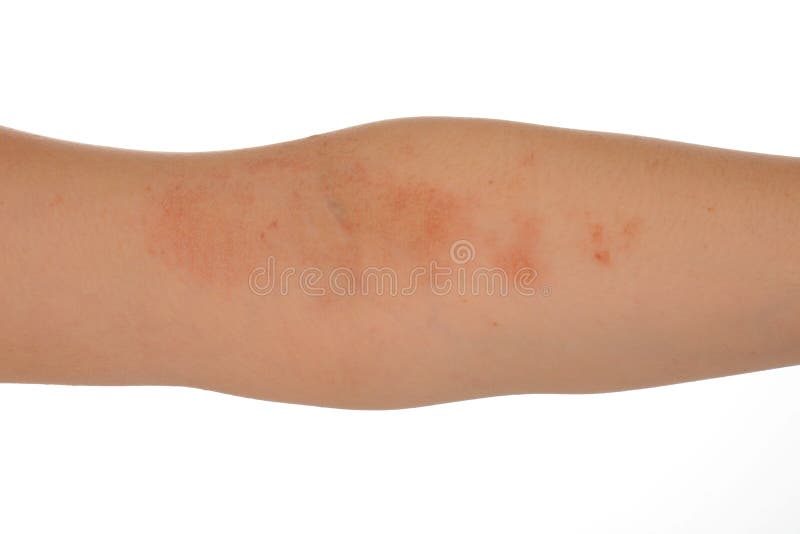 Eczema Skin Of Patient Stock Image Image Of Care Human 77908227