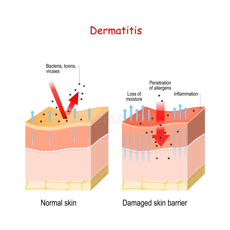 Dermatitis. Normal and skin with Damaged barrier. protection effect