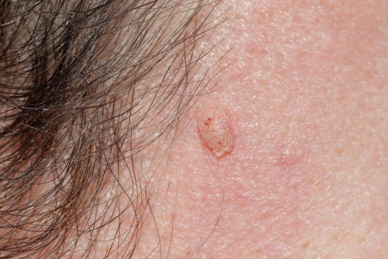 papilloma in face