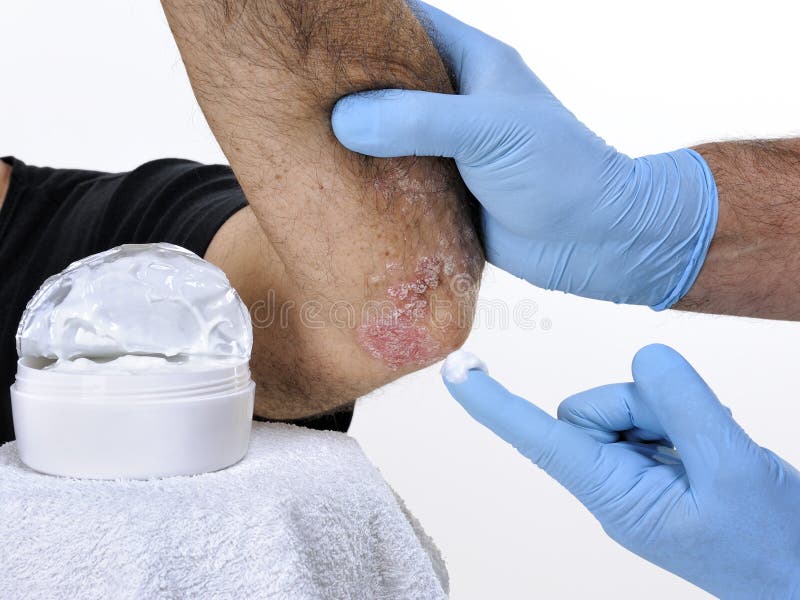 The dermatologist cure an adult man suffering from elbow psoriasis