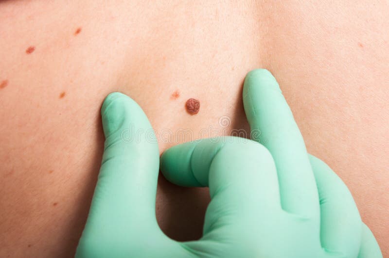 Dermatologist hand inspecting skin mole