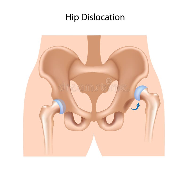 Hip dislocation, a common orthopedic injury, eps10. Hip dislocation, a common orthopedic injury, eps10