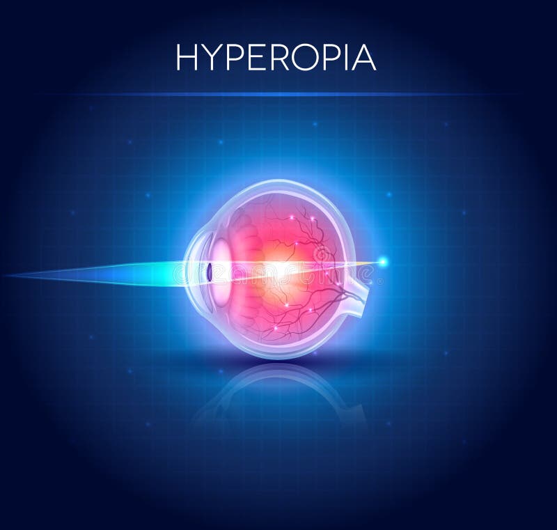 a hyperopia diagnózisa olyan mi a rövidlátás 6 dioptria