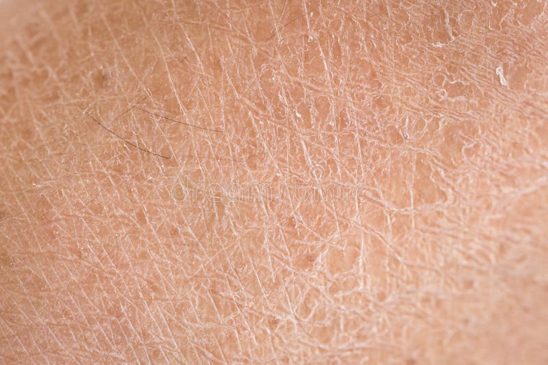 Detail der trockenen Haut (Ichthyosis)