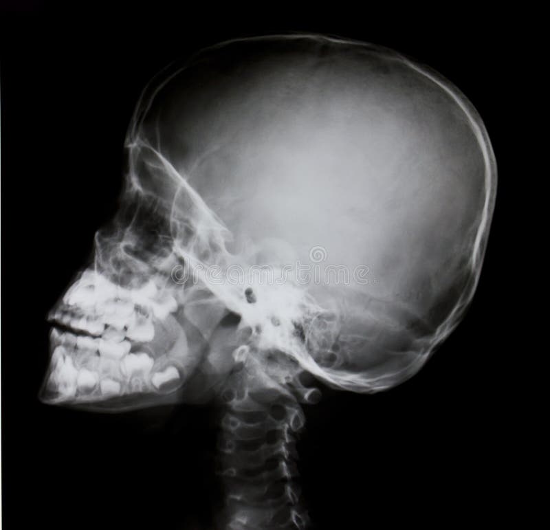2,035 X Ray Human Head Stock Photos Free & RoyaltyFree Stock Photos