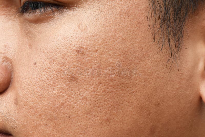 Pores and oily on surface young asian man face skin do not take care for a long time royalty free stock photo Pores and oily on surface young asian man face skin do not take care for a long time royalty free stock photo