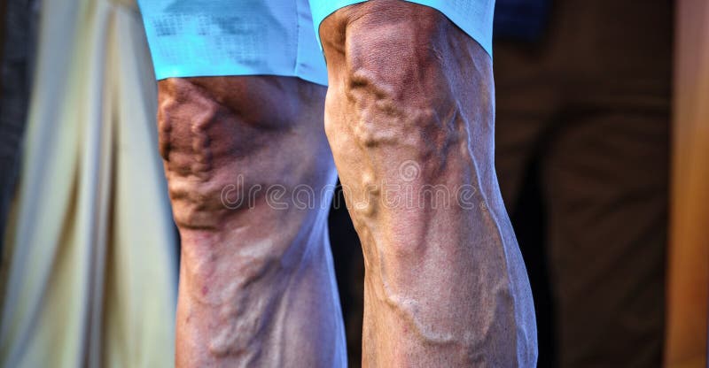 Detailed front view of cyclist sportsman legs with varicose and protruded veins. Detailed front view of cyclist sportsman legs with varicose and protruded veins
