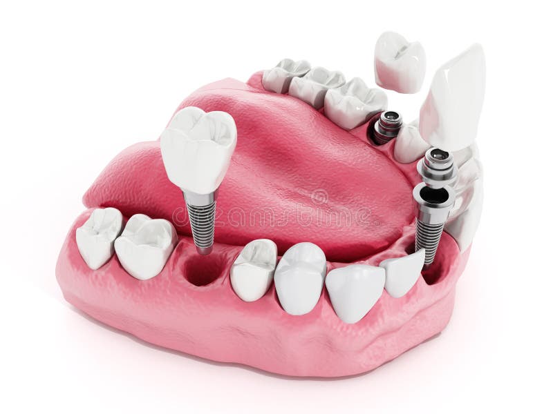Detaliu despre implantul dentar royalty free illustration