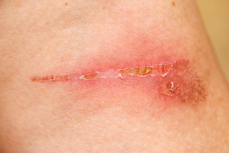 Detalle de la cicatriz de la quemadura