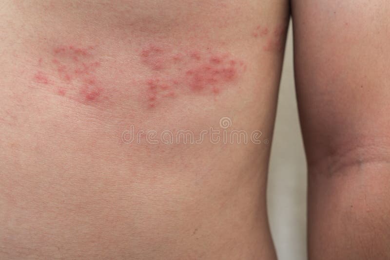 Detalle de la piel del cuerpo con las tablas del Zoster de herpes imagen de archivo Detalle de la piel del cuerpo con las tablas del Zoster de herpes imagen de archivo