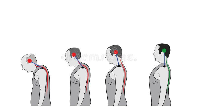 Development of a stooped stance with age, showing increasing curvature of the spine