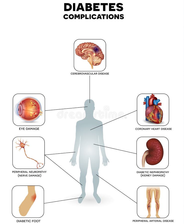 Posters On Diabetes Symptoms Risks Complications Posters On Diabetes Symptoms Risks Complications