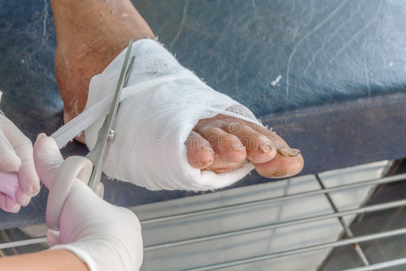 Diabetes foot ulcers royalty free stock photos Diabetes foot ulcers royalty free stock photos