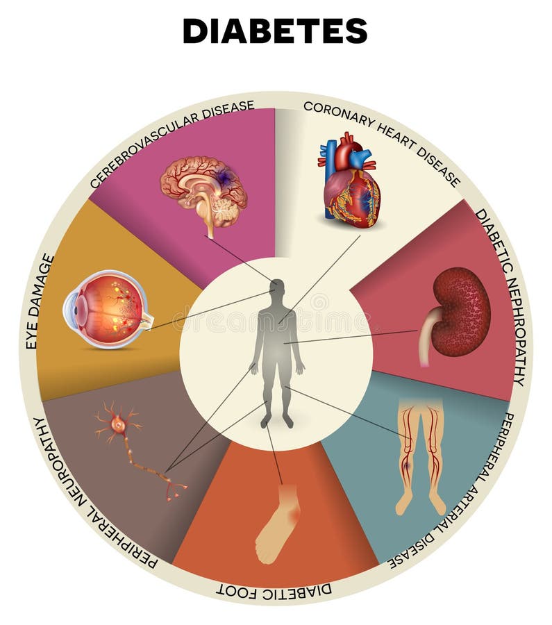 Diabetes mellitus info graphic