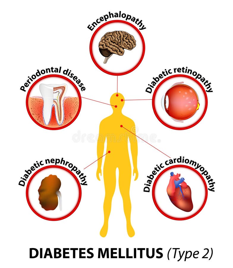 Il diabete mellito di tipo 2.