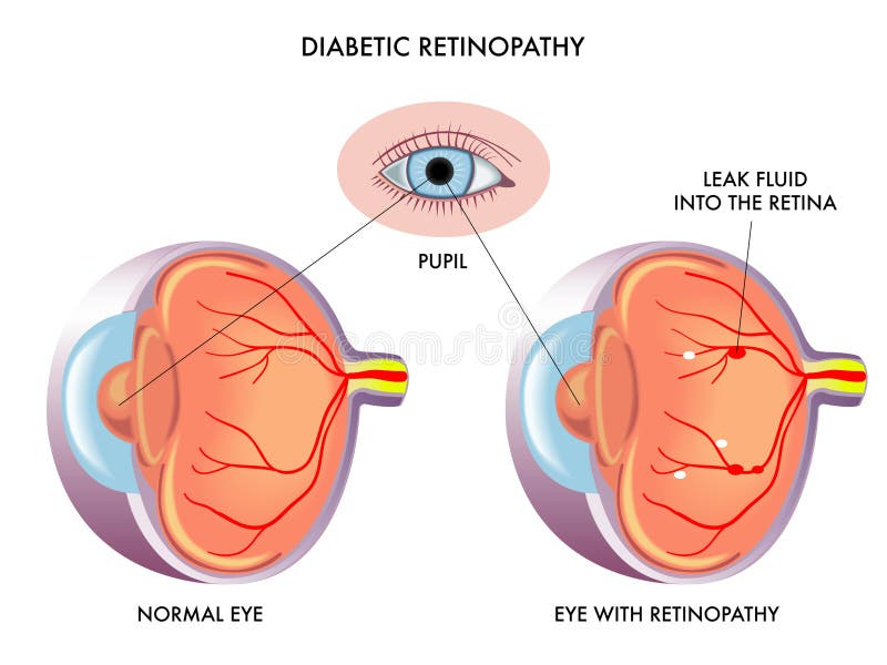 Ilustrácia príznaky diabetická retinopatia.