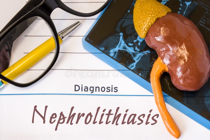 Diagnosis Nephrolithiasis photo. Figure of kidney lies next to incription of diagnosis Nephrolithiasis, MRI scan result, glasses a royalty free stock images