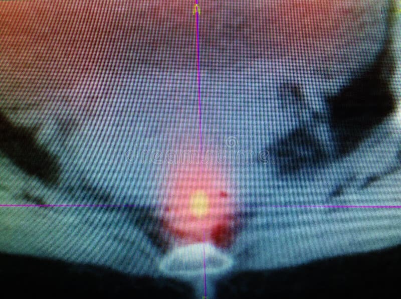 Colorectal cancer (also known as colon cancer, rectal cancer, or bowel cancer) is one of the most aggressive and dangerous cancer due to its spread in different parts of body. Pet/ct is very important tool for early diagnostic .Red with yellow colors in the area of pelvis with pathological tissue . Colorectal cancer (also known as colon cancer, rectal cancer, or bowel cancer) is one of the most aggressive and dangerous cancer due to its spread in different parts of body. Pet/ct is very important tool for early diagnostic .Red with yellow colors in the area of pelvis with pathological tissue .