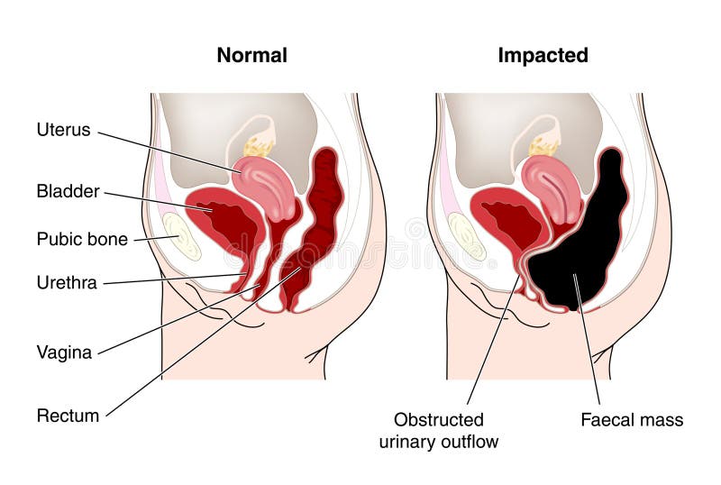 Cruz sección de barriga desplegado a constipación intestino.