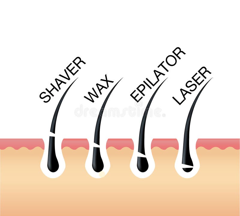 Diagram of Laser Hair Removal. Laser Hair Removal Stock Illustration