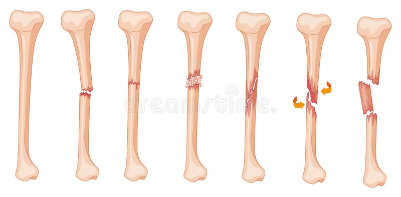 Diagram Of Leg Fracture In Different Stages Stock Vector ... from thumbs.dr...