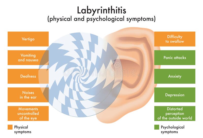 Peel Medical Practice - Labyrinthitis and vestibular neuritis are types of  inner ear infections that affect your balance. They usually get better on  their own within a few weeks. There are things