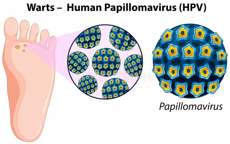 papillomavirus wratten