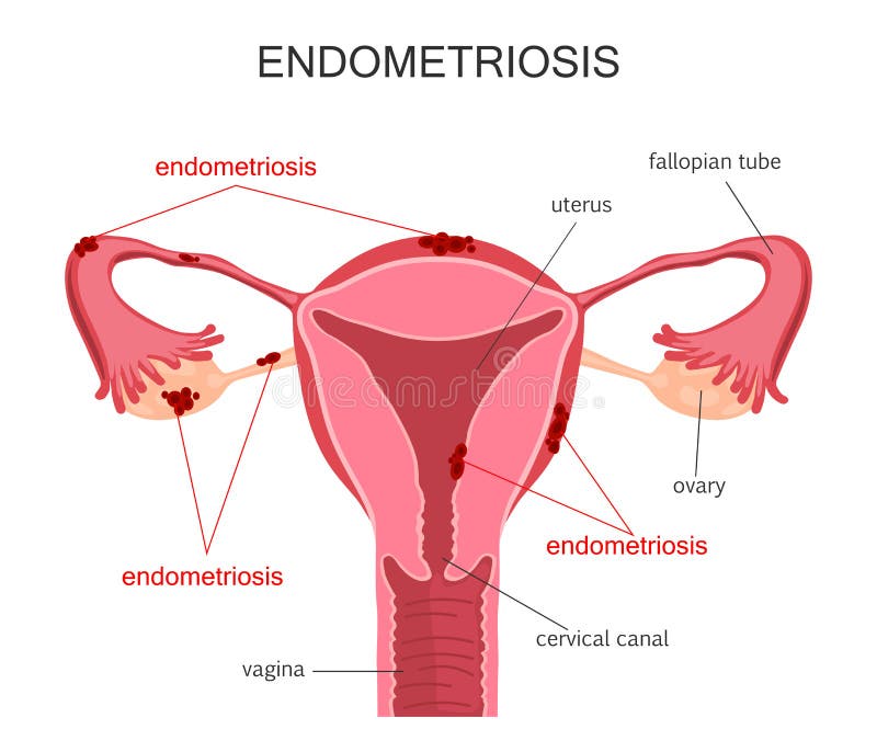 Diagrama de la endometriosis del útero