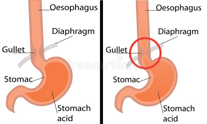 Diagrama del desease del reflujo gastroesofágico Ejemplo sano y de Gerd del estómago del vector stock de ilustración Diagrama del desease del reflujo gastroesofágico Ejemplo sano y de Gerd del estómago del vector stock de ilustración