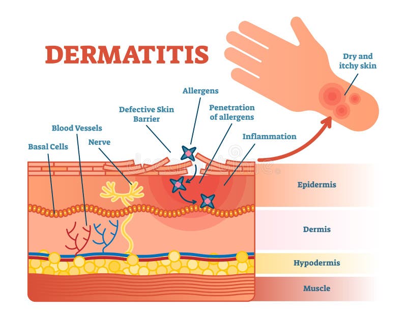 Diagrama liso da ilustração do vetor da dermatite com camadas da pele e movimento do alérgeno Informação médica educacional