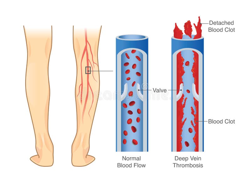 Diagrama médico de la trombosis profunda de la vena en el área de la pierna