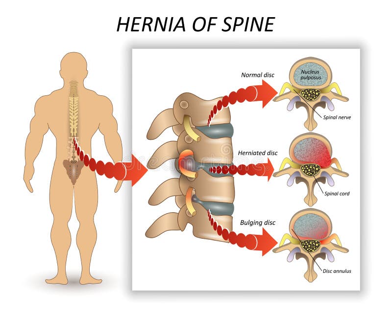 Diagramma medico di anatomia di una spina dorsale umana con l'ernia e la descrizione di tutti i sezioni e segmenti delle vertebre royalty illustrazione gratis Diagramma medico di anatomia di una spina dorsale umana con l'ernia e la descrizione di tutti i sezioni e segmenti delle vertebre royalty illustrazione gratis