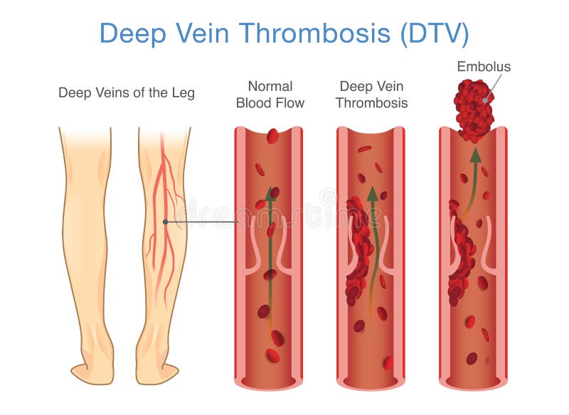Diagramma medico di trombosi venosa profonda ad area della gamba