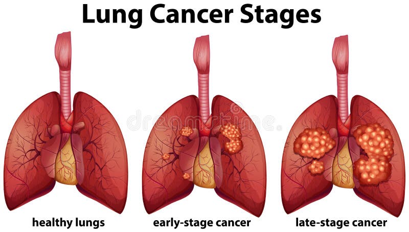 Diagramme montrant des étapes de cancer de poumon illustration libre de droits Diagramme montrant des étapes de cancer de poumon illustration libre de droits