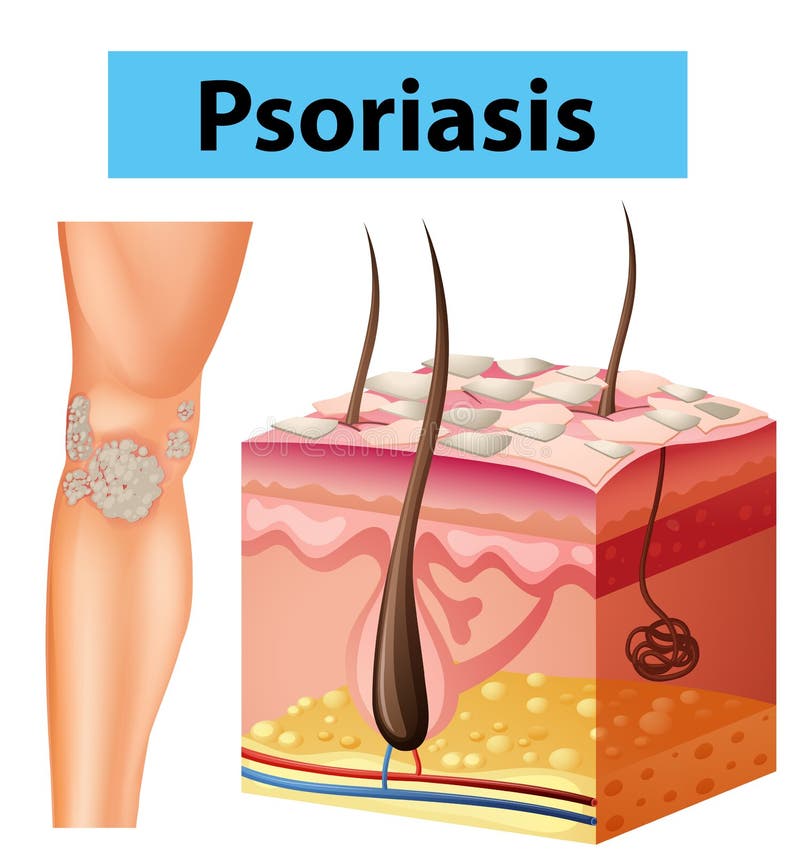 Diagramvisningpsoriasis på mänsklig hud royaltyfri illustrationer Diagramvisningpsoriasis på mänsklig hud royaltyfri illustrationer